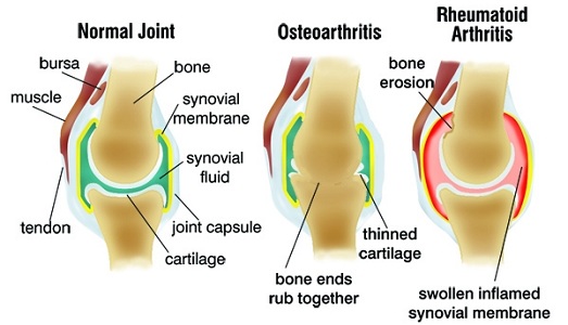 Osteoarthritis vs Rheumatoid Arthritis.jpg
